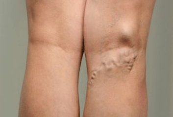 Diagnóza kŕčových žíl u tehotných žien