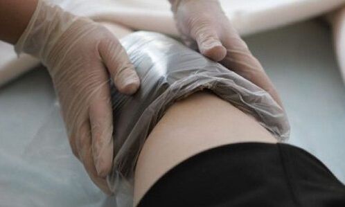 liečba kŕčových žíl obkladmi