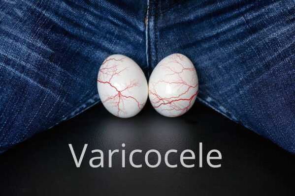 Varikokéla - rozšírenie žíl semennej šnúry